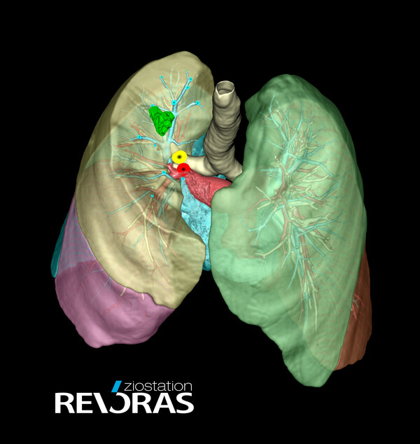 Olympus Launches AI-Powered Clinical Decision Tool for Surgical Planning in Partnership with Ziosoft